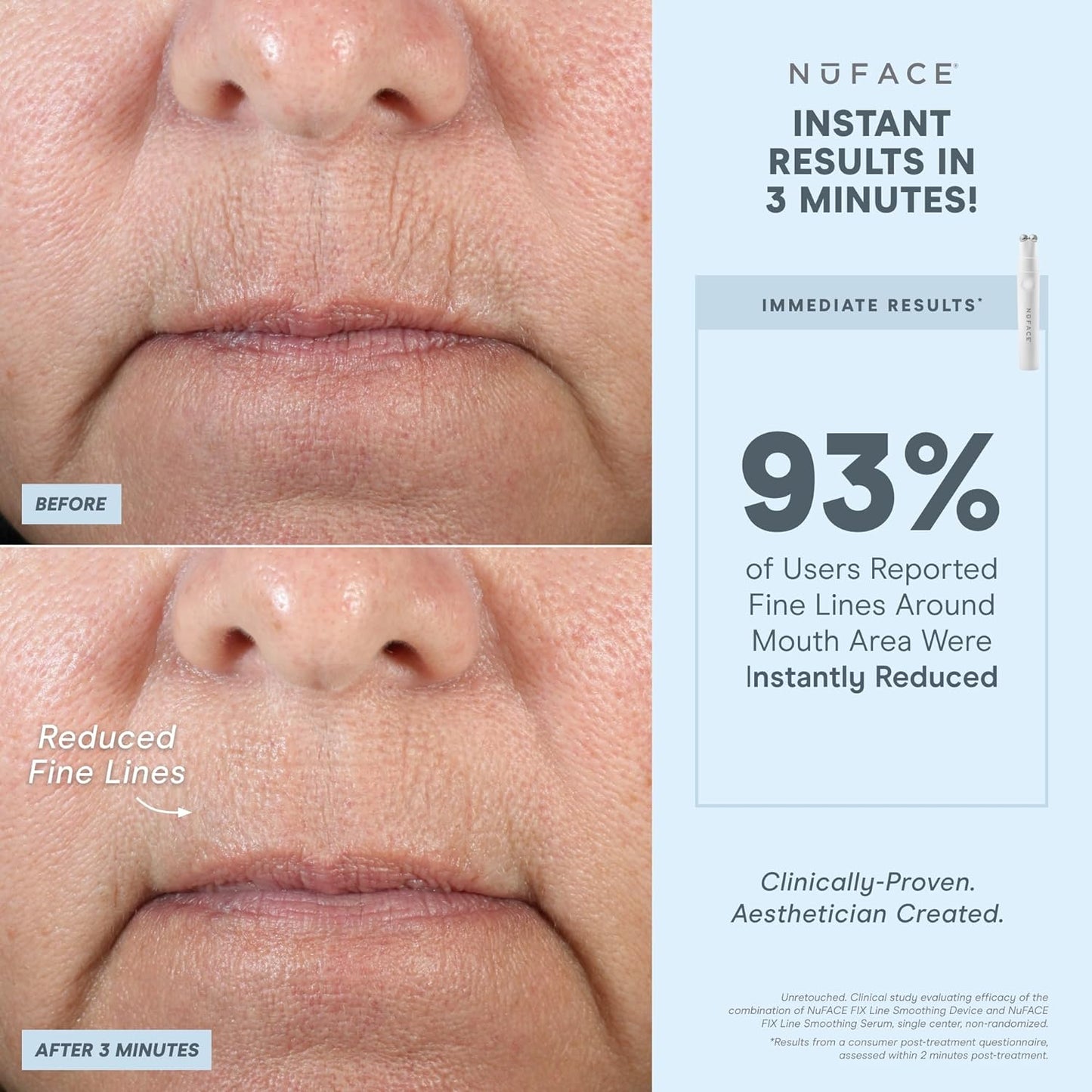 NuFACE FIX Starter Kit – Line Smoothing Device for Eyes, Mouth and Forehead, Blur Lines and Enhance Lip Fullness